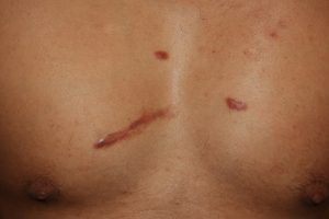 Chest Keloids