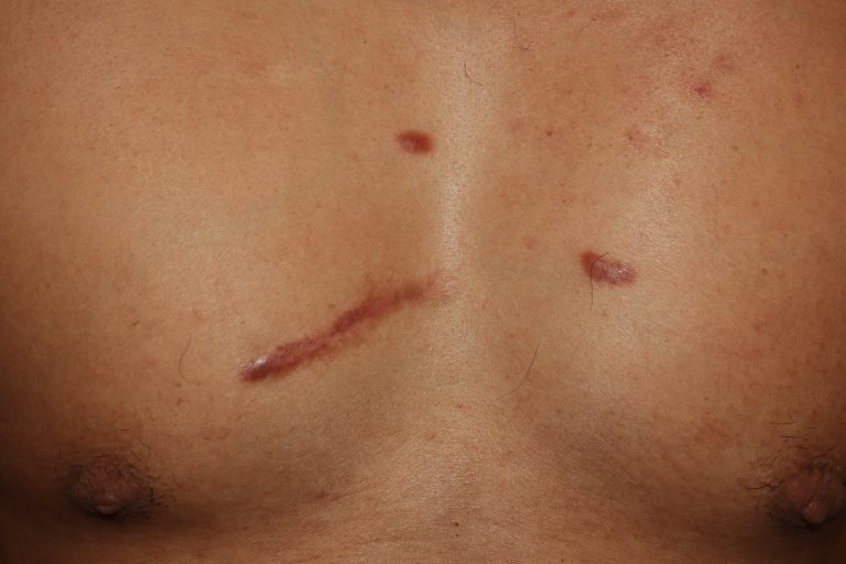 Chest Keloids - Follow up after three years