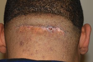 Scalp Keloid - Results with Multi-Modality Treatment Plan