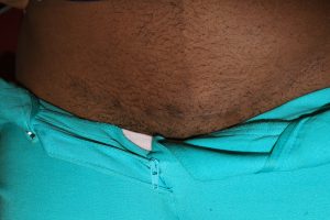 Pubic Keloid - Results with Multi-Modality Treatment Plan