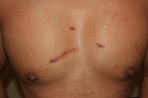 Chest Keloids - Treatment Results with Intralesional Chemotherapy.