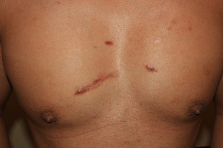 Chest Keloids - Follow up after three years