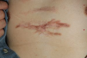 Chest Keloids - Treatment Results with Intralesional Chemotherapy.