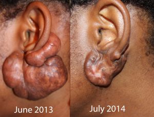 Massive Ear Keloids - Treated with Cryotherapy