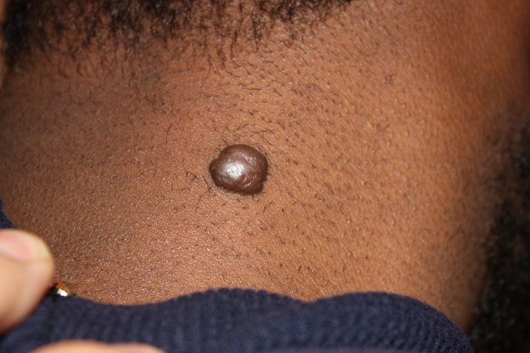 Nodular Keloids