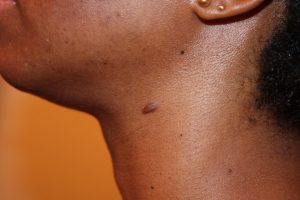 Papular Neck Keloid