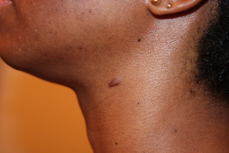 Papular Keloids