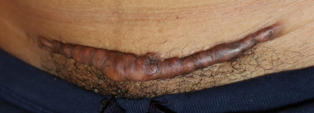 post c-section keloid