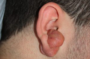 complex ear keloid