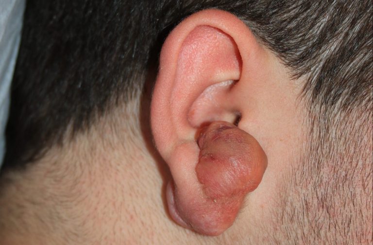 Large Complex Right Ear Keloid Large Complex Right Ear Keloid