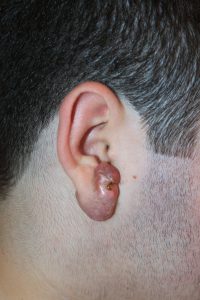 Earlobe Keloid - Interim Results with Cryotherapy