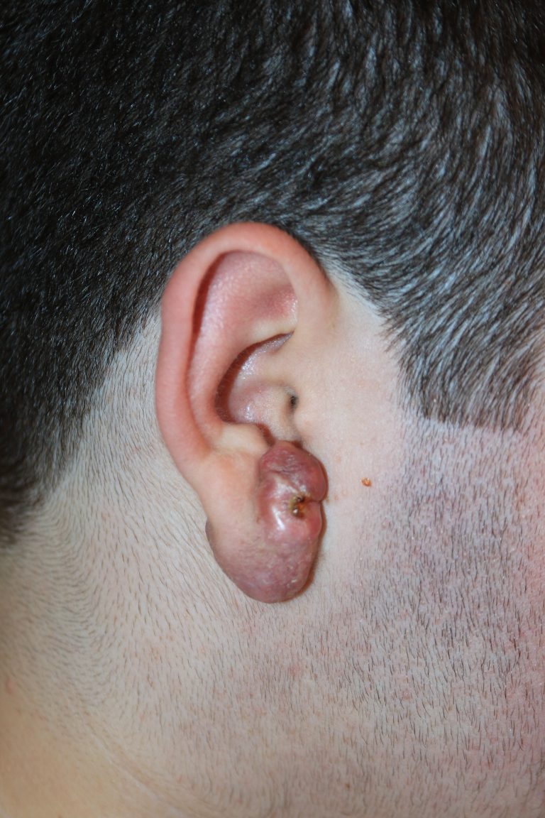 Large Complex Right Ear Keloid