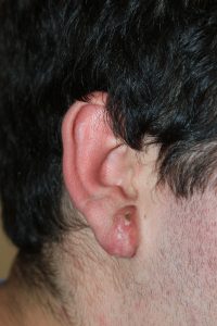 Earlobe Keloid - Treatment Results with Cryotherapy