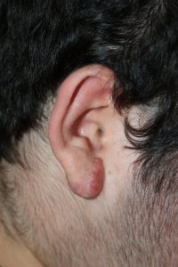 Treatment outcome using cryotherapy