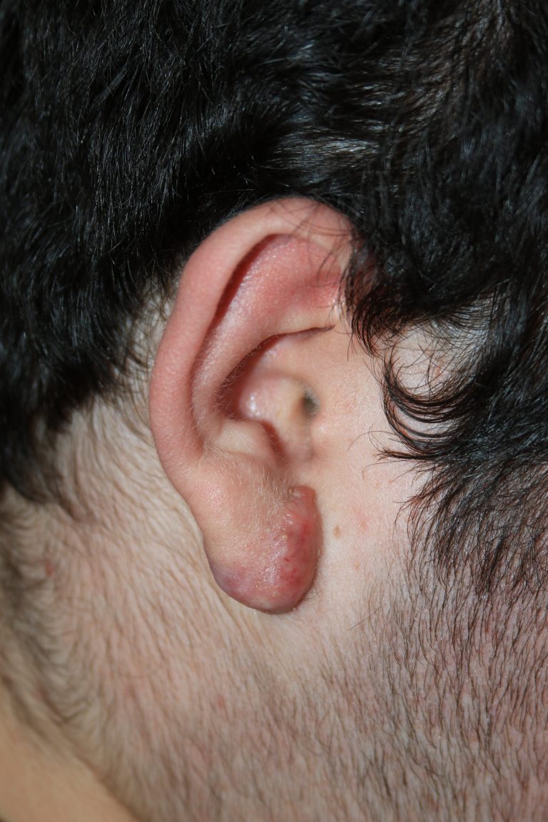 Large Complex Right Ear Keloid