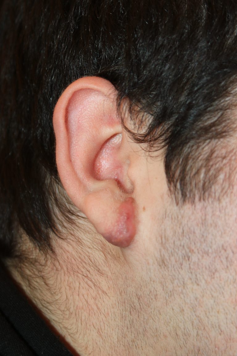 Large Complex Right Ear Keloid