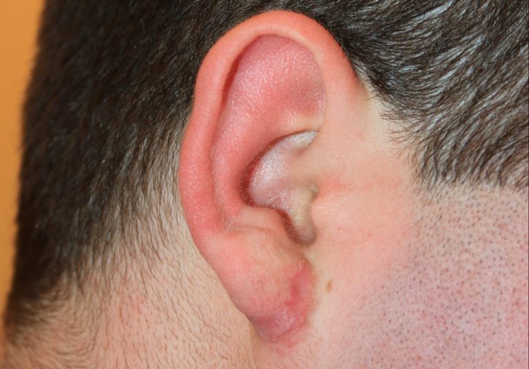 Large Complex Right Ear Keloid