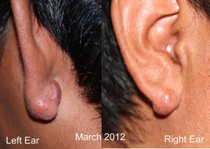 Earlobe Keloids - Recurrence after surger