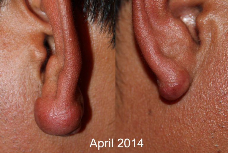 Bilateral Ear Keloids - Follow Up