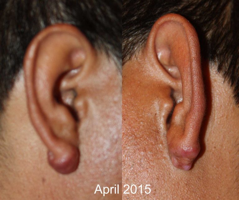 Bilateral Ear Keloids - Follow Up 2