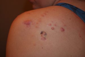 Multiple Acne Induced Shoulder Keloids