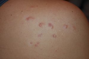 Multiple Acne Induced Shoulder Keloids