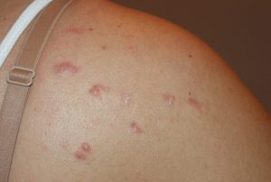 Multiple Acne Induced Shoulder Keloids