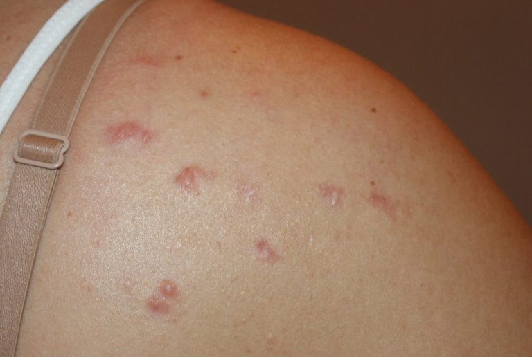 Acne Chest Keloids