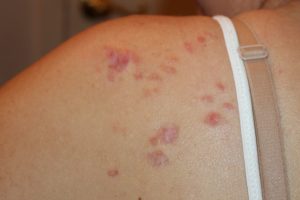 Multiple Acne Induced Shoulder Keloids