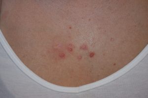 Chest Keloids