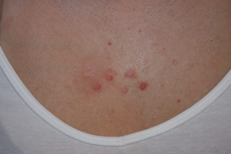 One year later - July 2015 Acne Chest Keloids