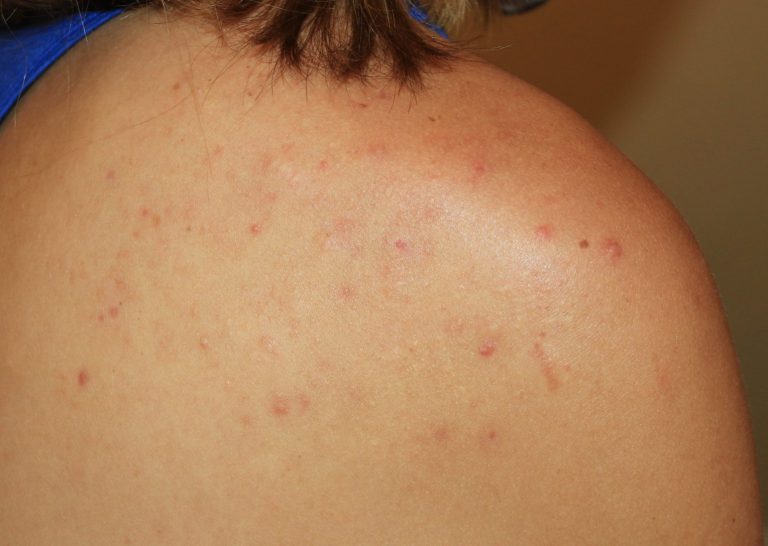 Acne Chest Keloids