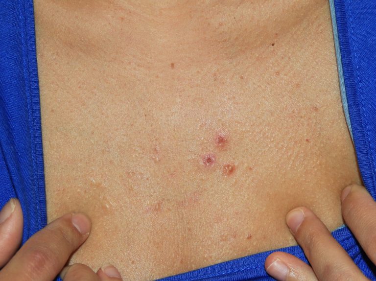 Acne Chest Keloids