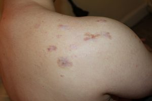 Shoulder Keloids - Treatment results with multimodal non-surgical treatments