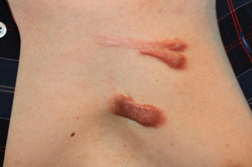 Challenging chest keloid treated with chemotherapy