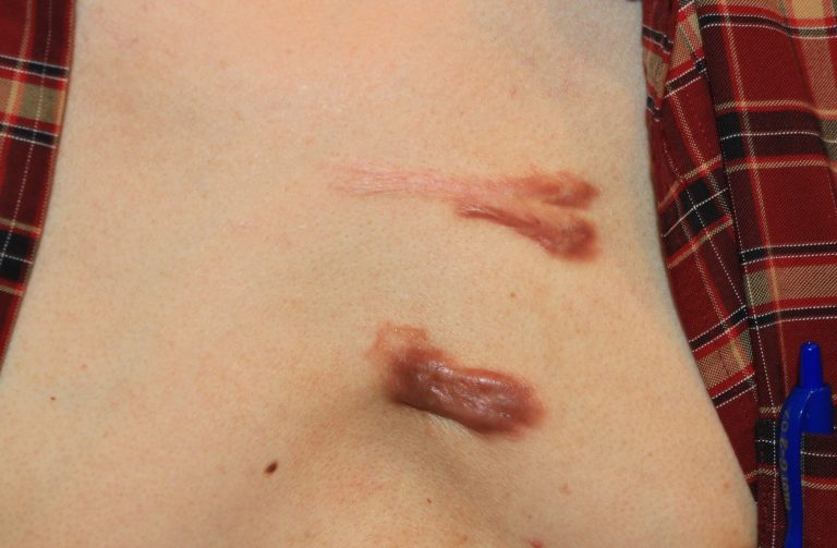 Inflammatory chest keloids