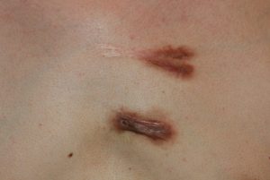 Chest keloids undergoing treatment