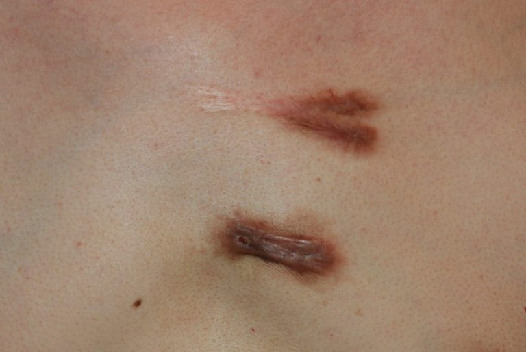 Inflammatory chest keloids