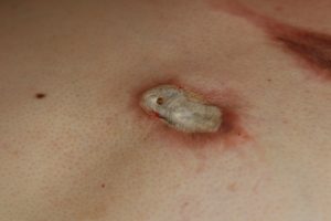 Chest Keloid Immediately after application of cryotherapy