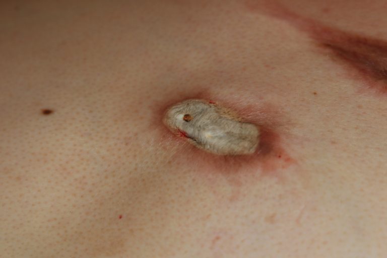 Inflammatory chest keloids