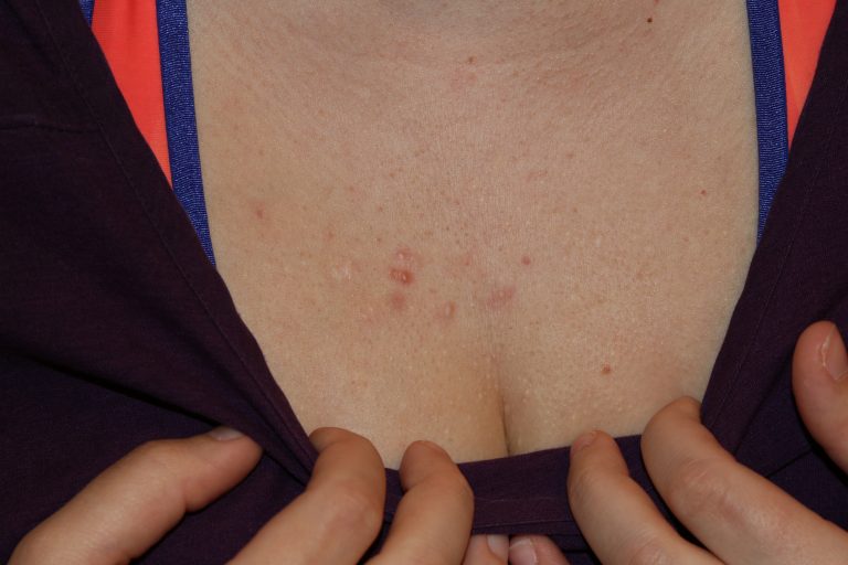 Acne Chest Keloids