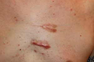 Linear Chest keloids