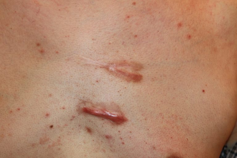 Inflammatory chest keloids