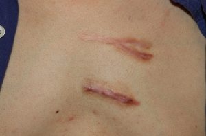 Linear Chest keloids