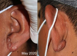 Earlobe Keloids - Recurrence after surger