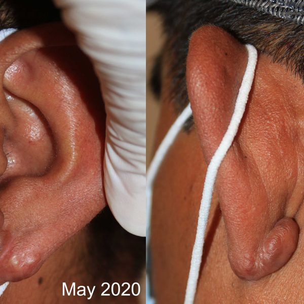 Radiation therapy for Ear Keloids