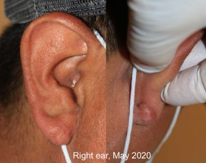 Earlobe Keloid - Recurrence after surgery