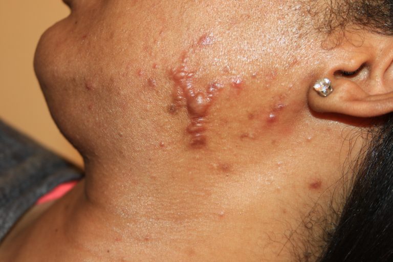 Keloids on the left side of the face