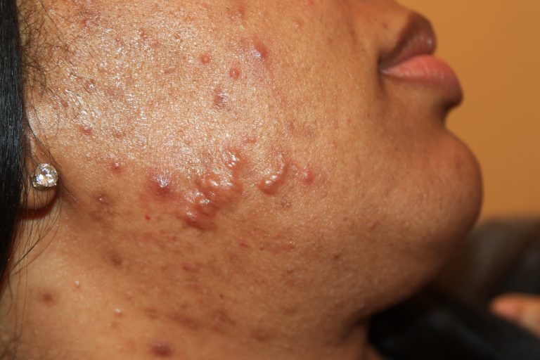 Keloids on the right side of the face