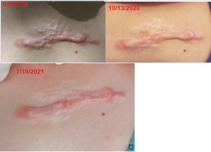 Effect of R6 cream on Chest Keloids. 